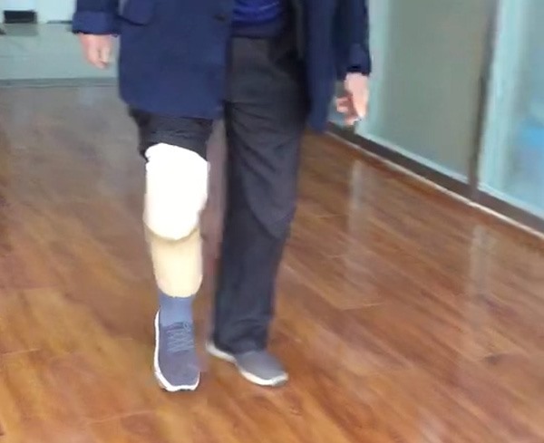 小腿假肢定制