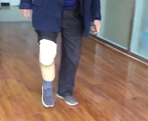 小腿假肢定制